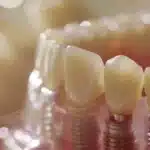 a radiant smile showcasing gleaming dental implants against a softly lit, serene backdrop, emphasizing the transformative benefits of oral health.