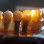 a striking contrast between a gleaming dental implant and a worn denture, illuminated in soft natural light, highlighting the durability and modern design of dental implants against the historical backdrop of traditional dentures.