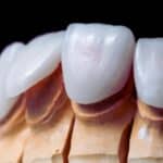 porcelain crowns for front teeth the key to a seamless smile