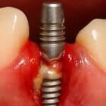 Infected Dental Implant