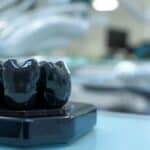 Blackened tooth crown illustrating causes of discoloration and dental issues.