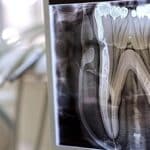 X-ray image showing dental crown with potential cavity underneath.