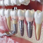 Close-up of dental model highlighting common implant complications
