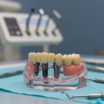 Dental implant model highlighting titanium and zirconia materials in a clinical setting
