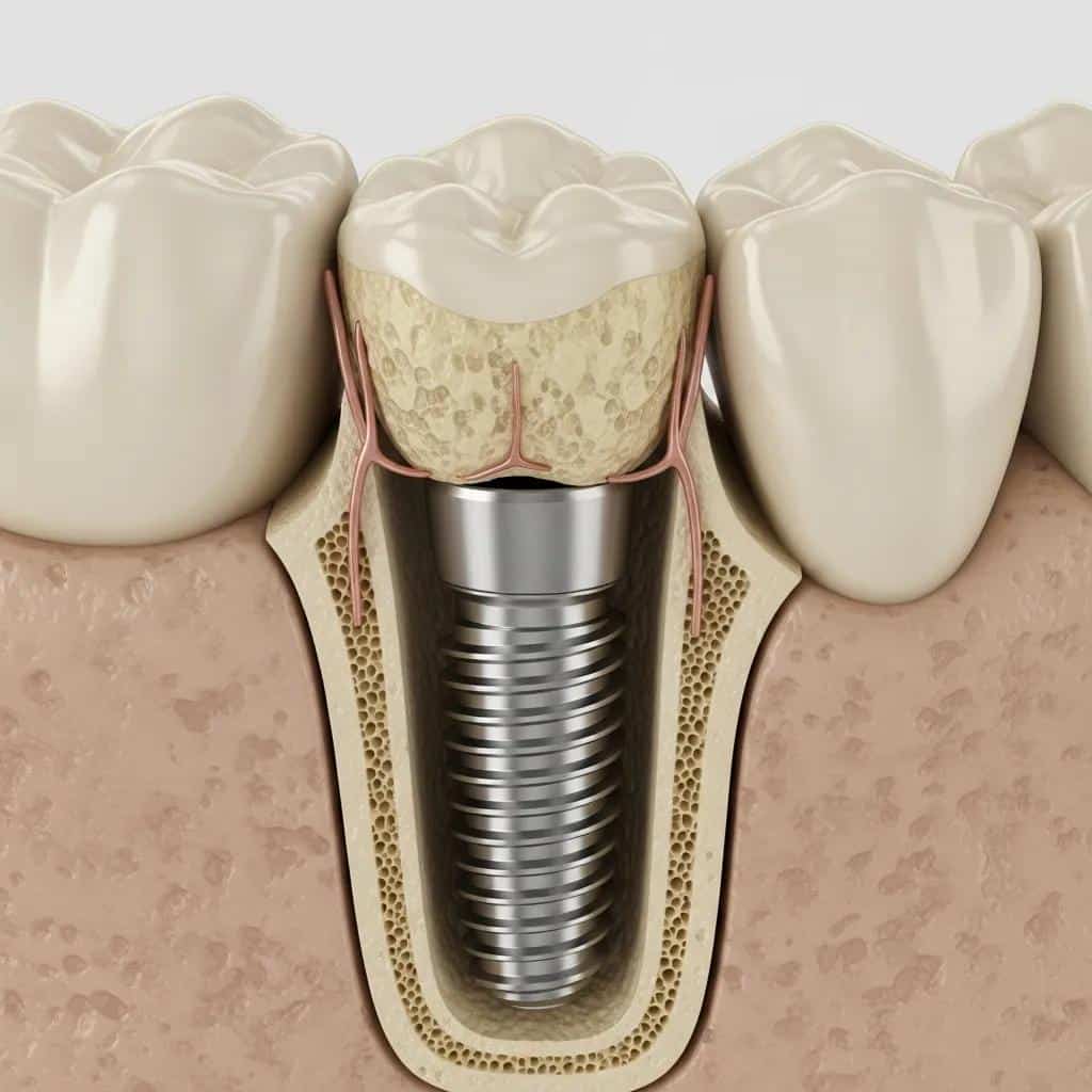 Model showing an endosteal dental implant placed in the jawbone