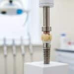 Dental implant model in a modern dental office, highlighting the components of dental implants