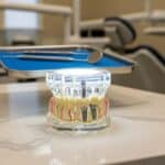 Dental implant model on a dental office countertop, emphasizing the healing process