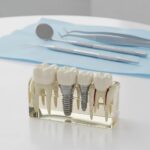 Dental implant model for molars demonstrating advanced restorative dentistry technology