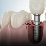 Illustration of a dental implant