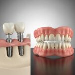 Comparison of dental implants and dentures highlighting comfort differences