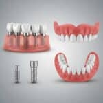 Comparison of dental implants and dentures highlighting their differences
