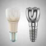 Comparison of ceramic and titanium dental implants highlighting their distinct materials and aesthetics