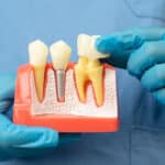 Dental Crowns in Tyler