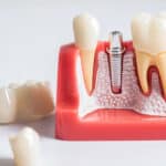 Dental Implants in