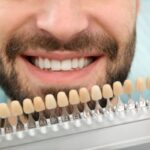 Veneers in DeSoto