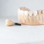 Dental Implants in Tyler
