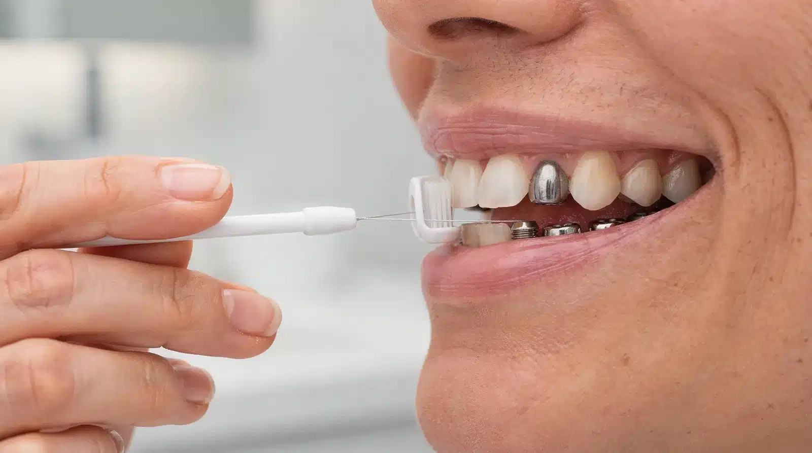 Brush at least twice a day for two minutes to maintain implant hygiene.; Use non-abrasive