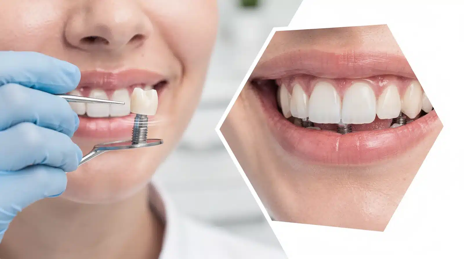 When bone doesn't grow properly around an implant, the main sign is often mobility