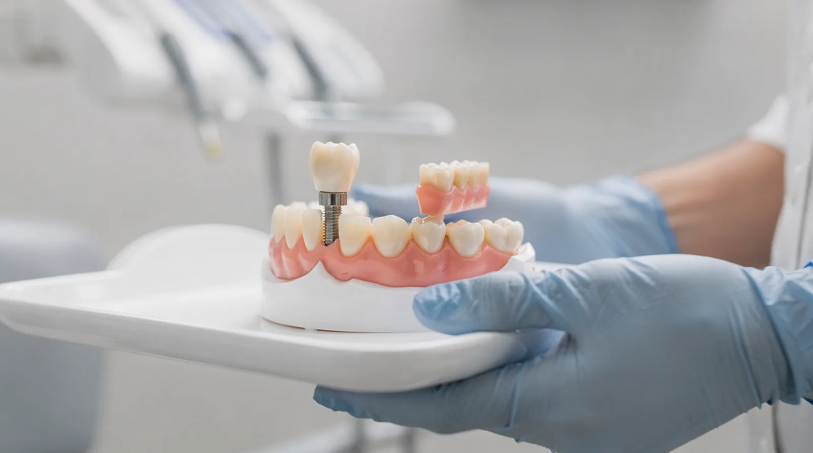 Unlike removable dentures or fixed bridges, implants are a permanent fixture designed to look