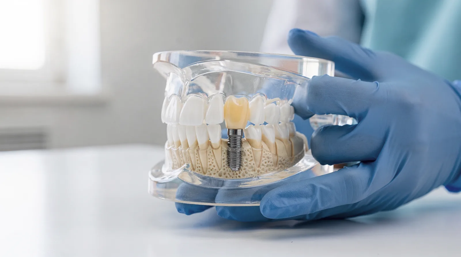 An implant looks and functions like a natural tooth, letting patients chew and floss normally