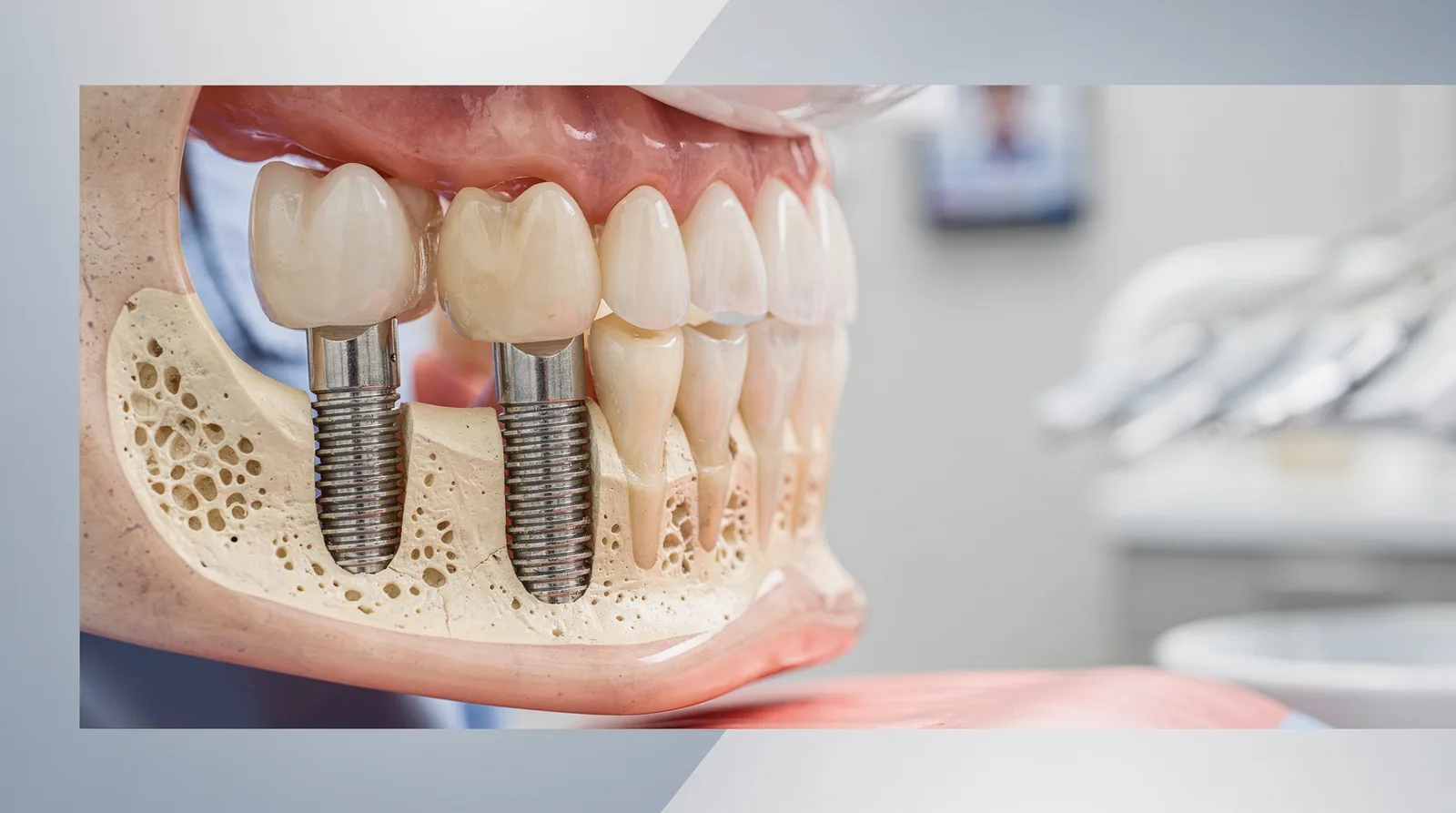 Titanium or ceramic posts integrate with bone in a process called osseointegration.; This bone integration