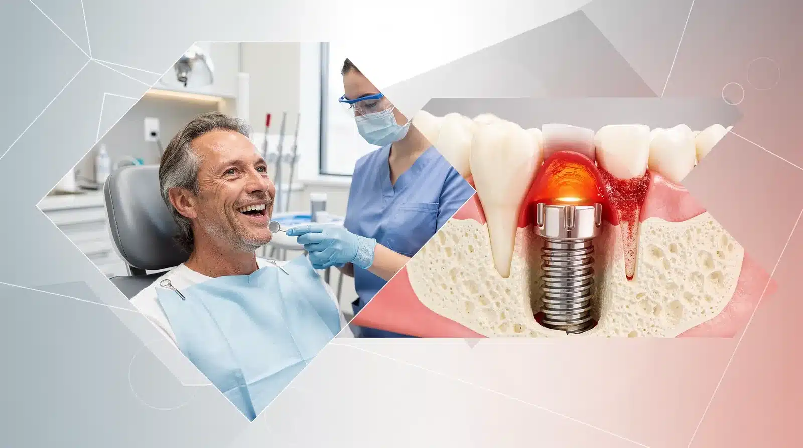 Dental implants are surgically placed titanium posts that function as replacement tooth roots.; Peri-implantitis