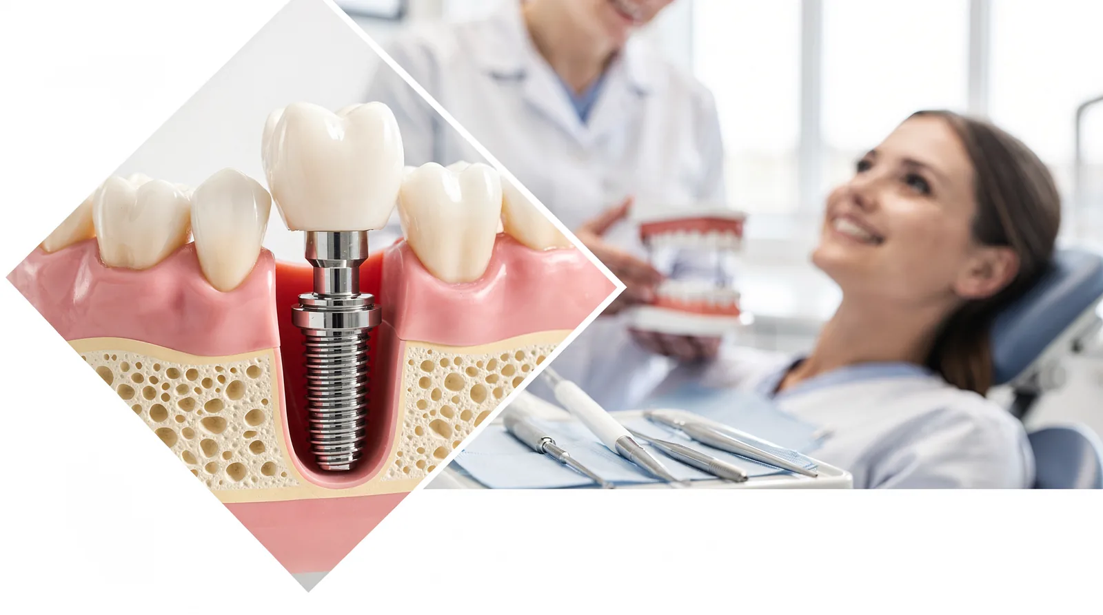 A single tooth implant replaces both the lost tooth and its root. The process involves