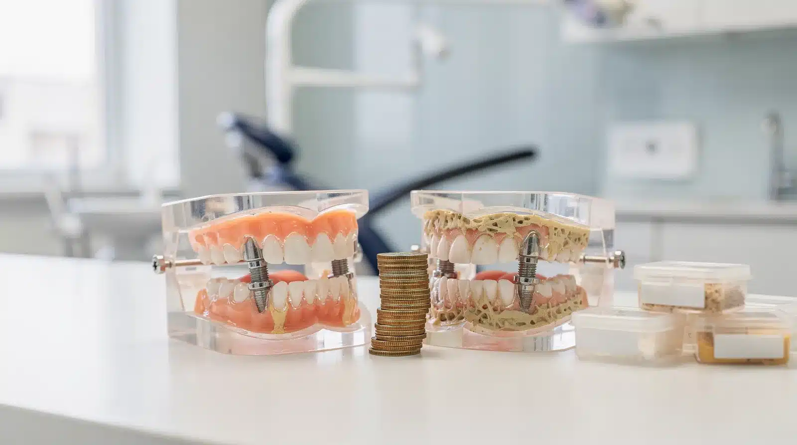 How does bone graft cost affect implant pricing