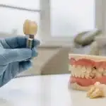 What is the value of dental implants